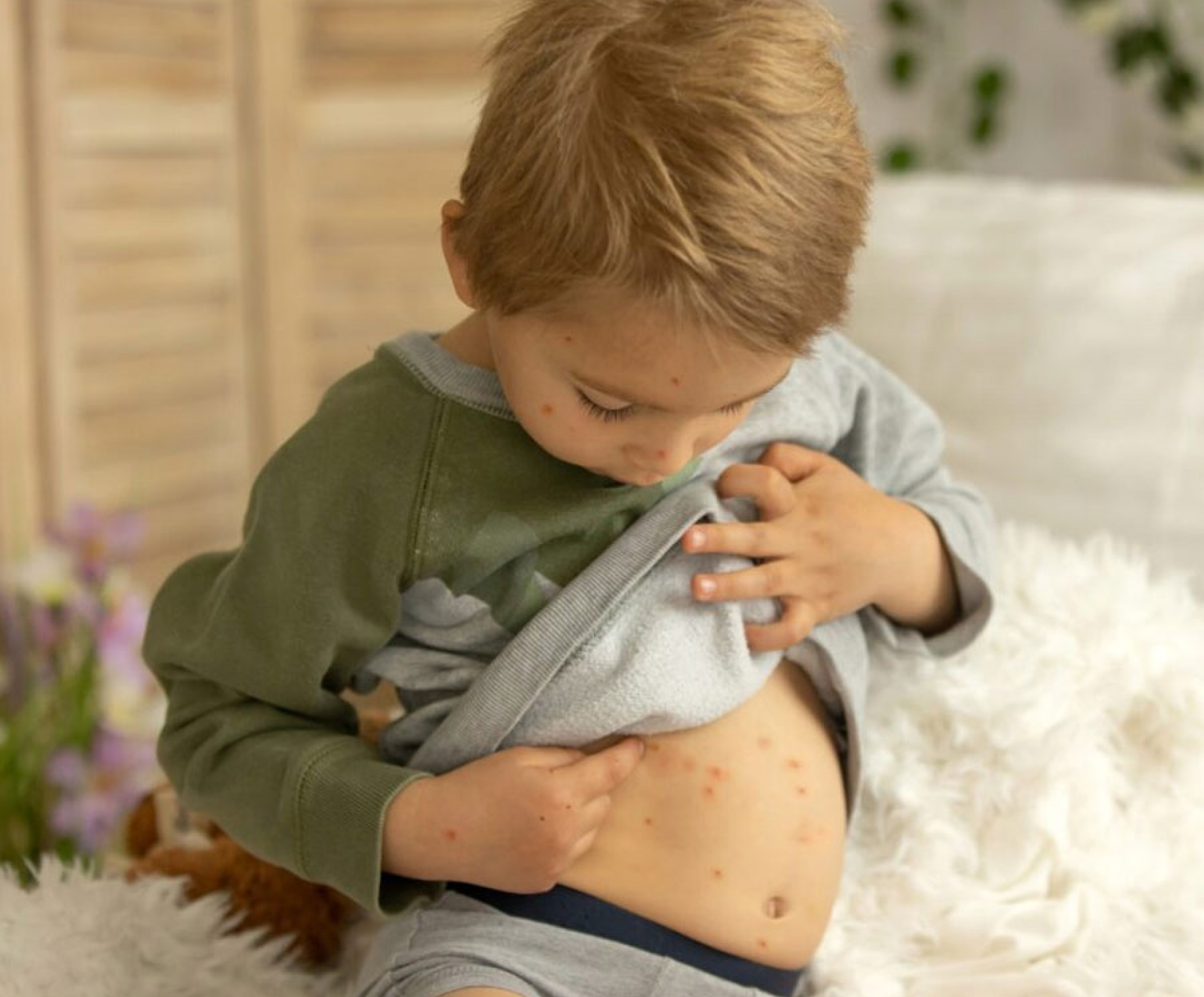 Les soins pour traiter les boutons de varicelle