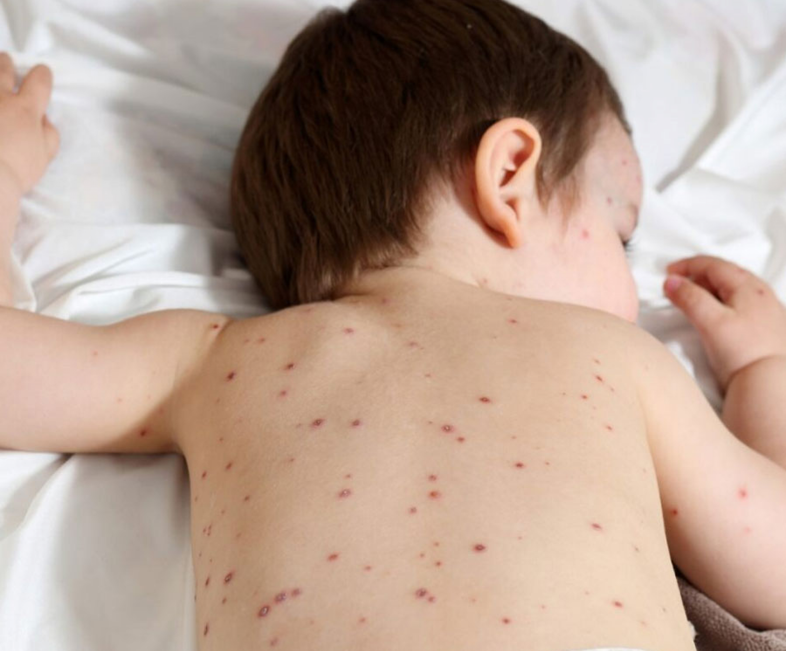 Varicelle et contagion : comment l’éviter ?
