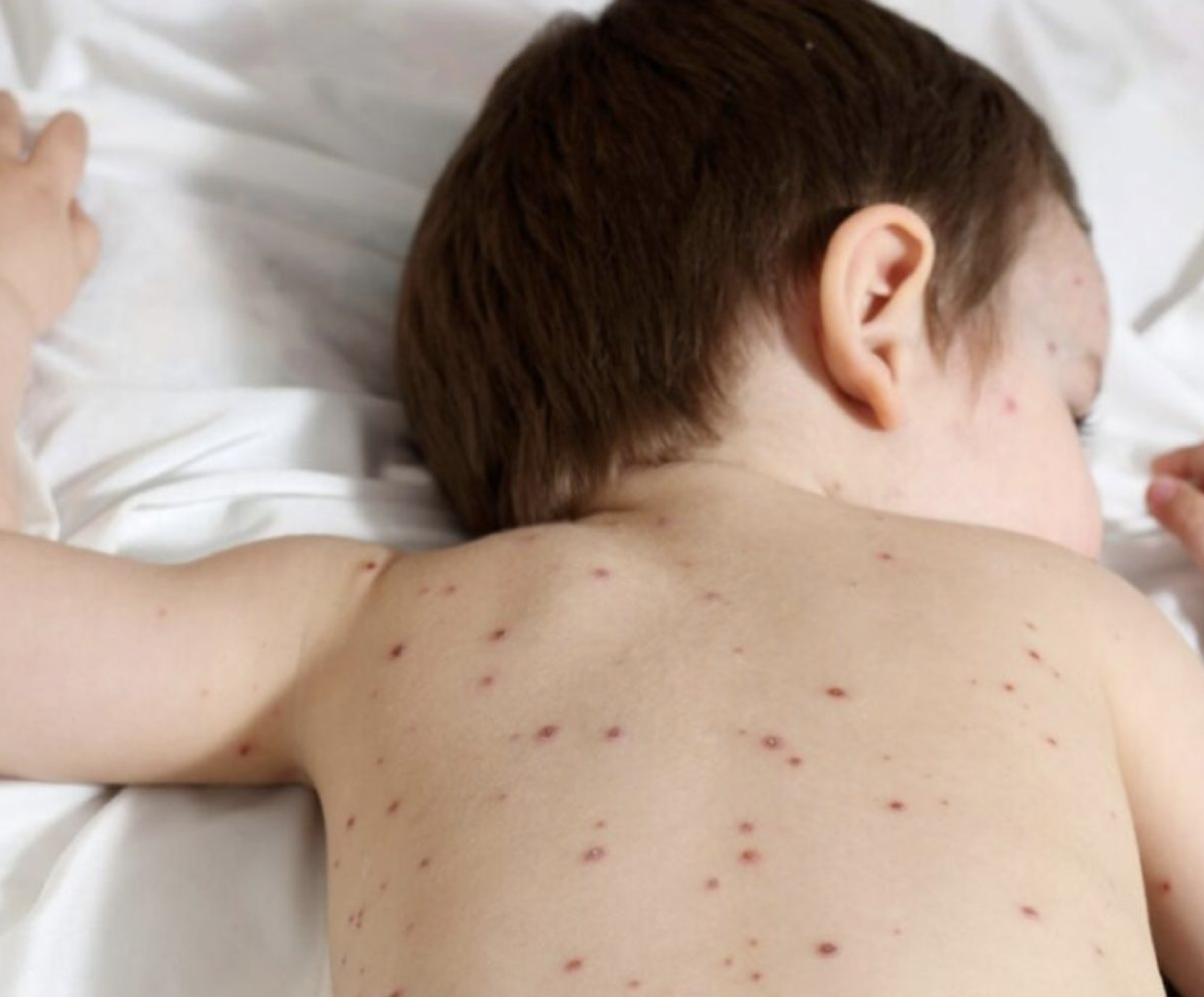 Varicelle et contagion : comment l’éviter ?